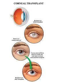 cornea-Transplant