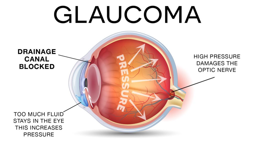 glaucoma