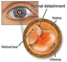 retina