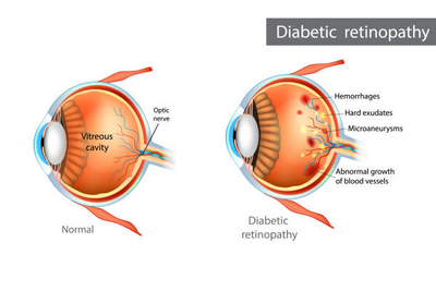 What is Diabetic Retinopathy