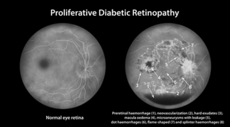 Fluorescein Angiography