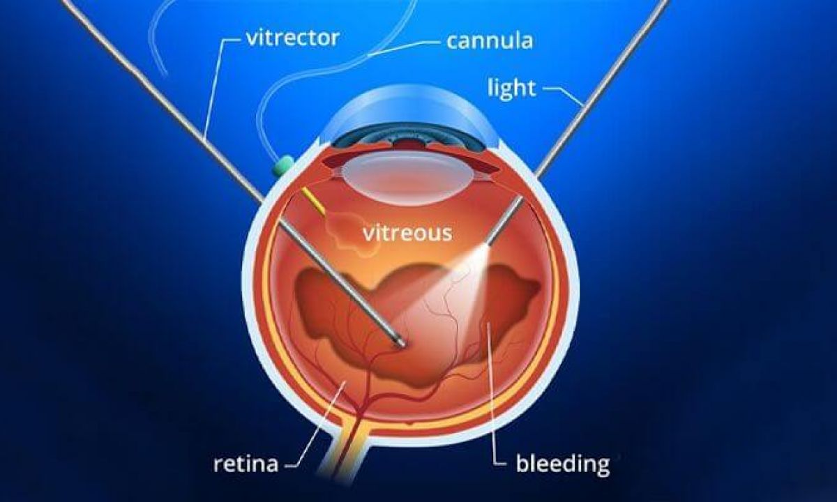 Vitrectomy Surgery