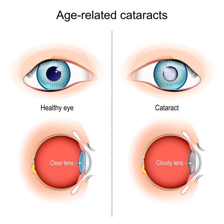 age related cataracts