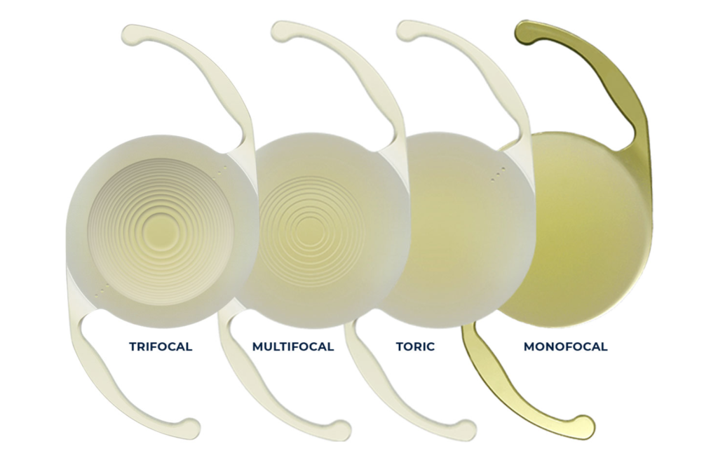 "Comparison of four types of intraocular lenses (IOLs)—trifocal, multifocal, toric, and monofocal—showing their distinct designs and purposes for vision correction after cataract surgery."