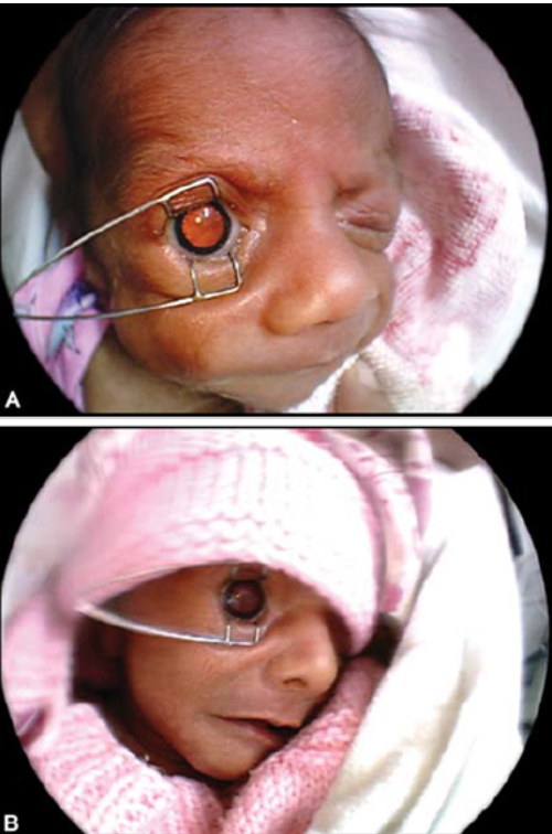 Two clinical images of a premature newborn undergoing an eye examination showing the use of an eyelid speculum to keep the eye open while the retina is examined for retinopathy of prematurity ROP