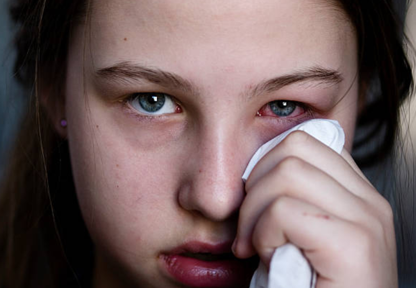 Red eye infection with watering and irritation conjunctivitis symptom