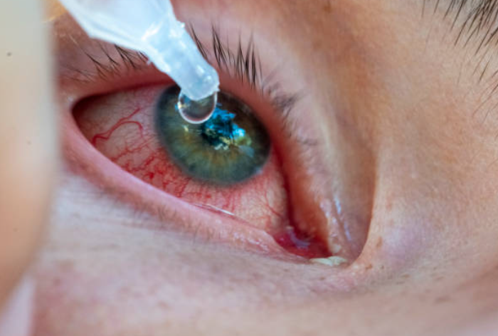 Close up red eye conjunctivitis treatment using eye drops