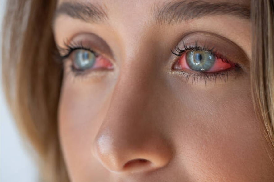 Close up of red eye due to conjunctivitis with inflamed sclera and irritation