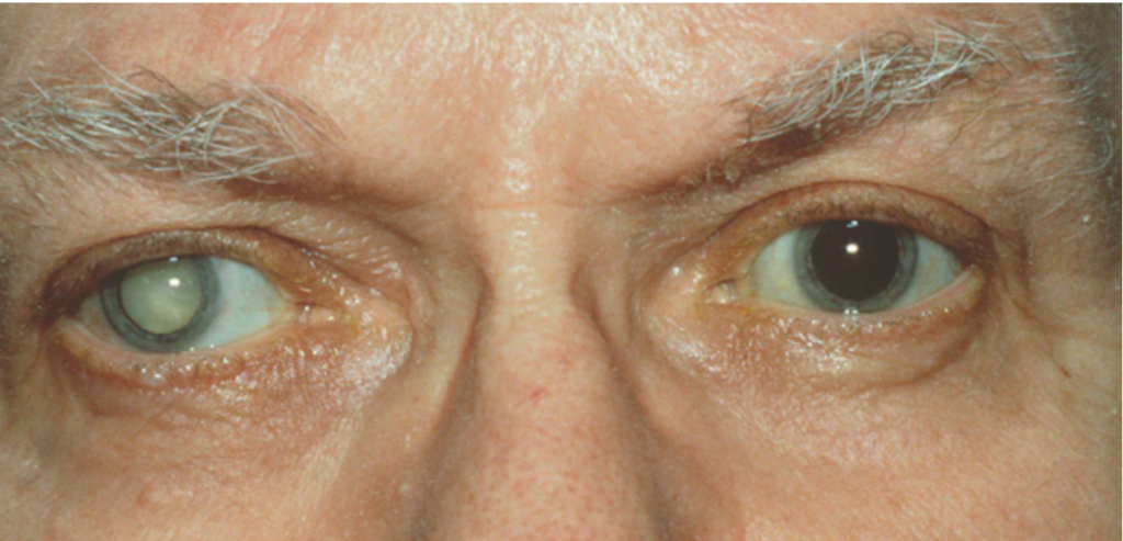 patient with mature cataract Crystal Clear Eye Clinic Best Eye Clinic in Andheri Mumbai patient with mature cataract