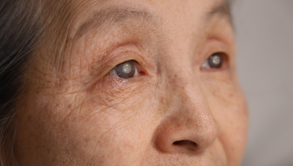 lady having dense cataract in both eyes